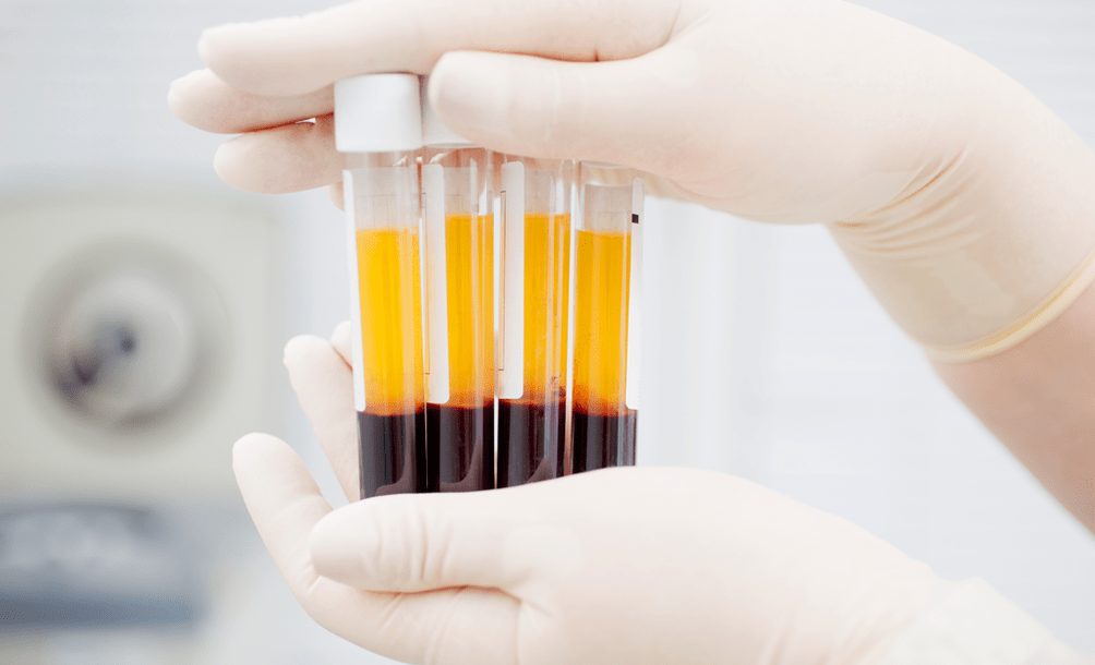 Plasma rico en plaquetas para terapia PRP para osteoartrite
